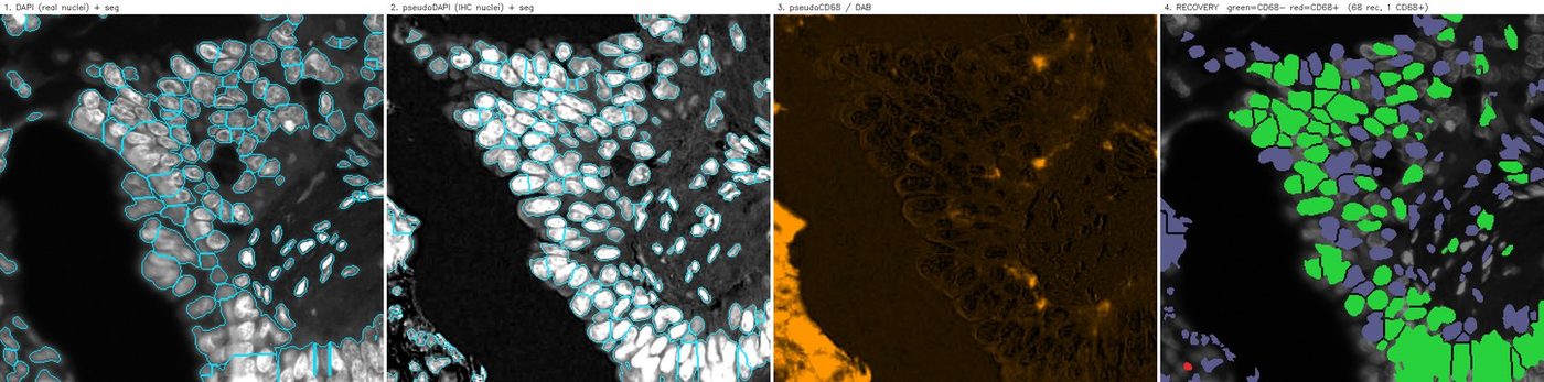 CD68 IHC recovered into the multiplex immunofluorescence coordinate grid
