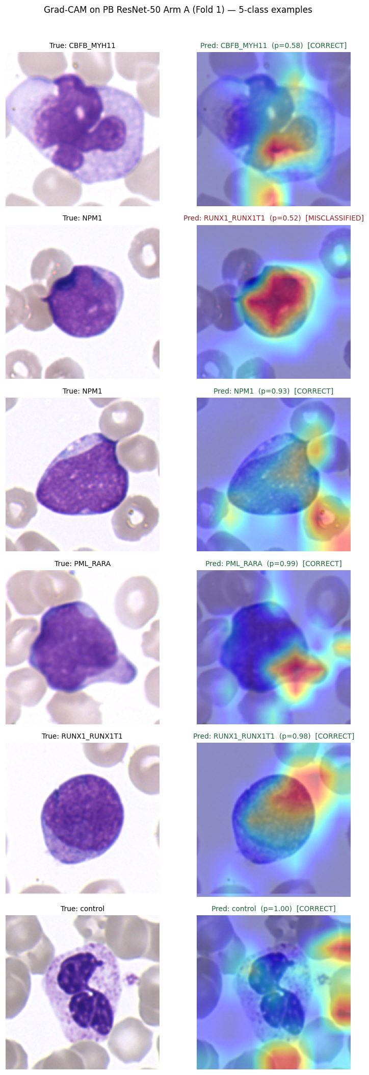 Grad-CAM attention overlays on peripheral-blood white cells across five AML cytogenetic subtypes