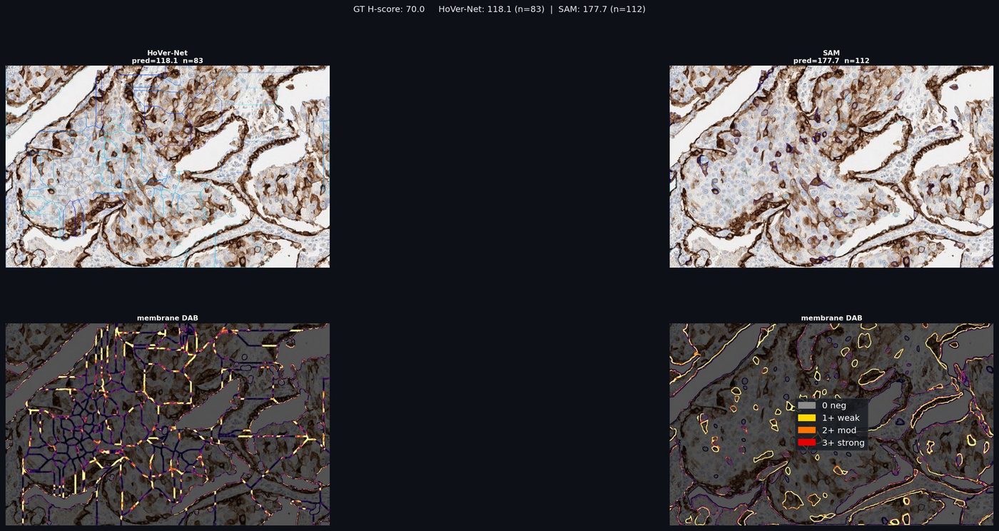 TROP2 IHC per-cell membrane scoring and DAB optical-density analysis