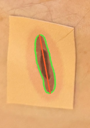 Automated wound delineation: green boundary and red greatest-dimension on a scale-rectified frame
