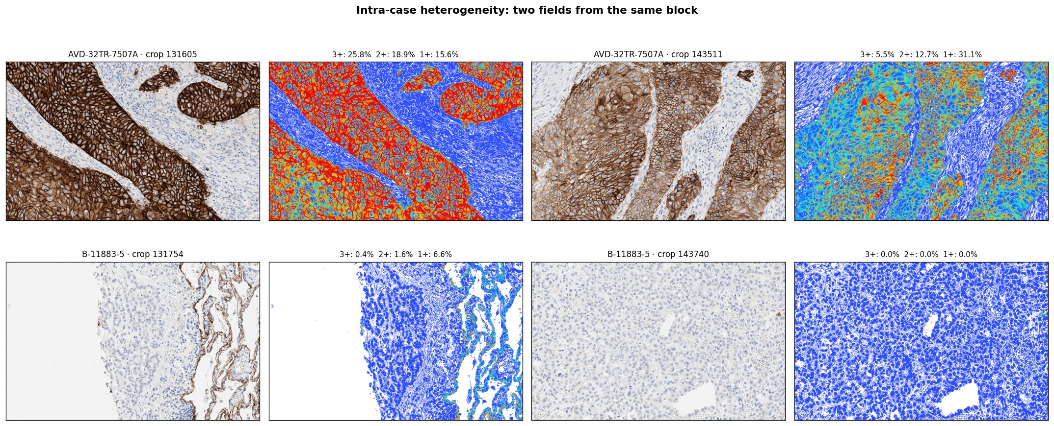 TROP2 IHC Scorer -- intra-case heterogeneity across two cases